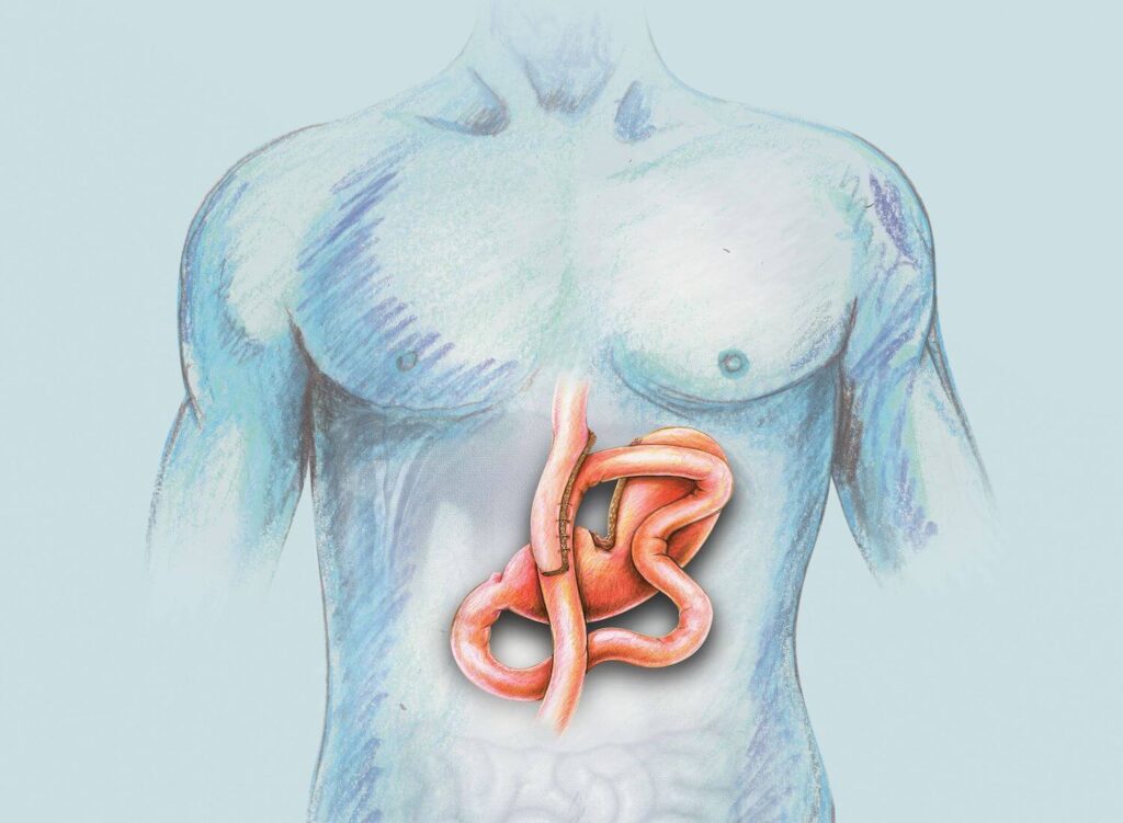 Illustration of a human torso showing a diagram of the stomach and intestines, highlighting a section of the digestive system.