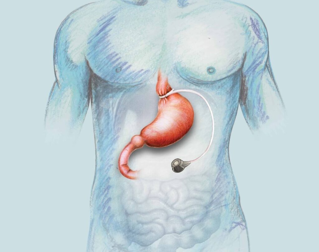 Medical illustration of a human torso showing a gastric band placed around the upper part of the stomach with a connected port.